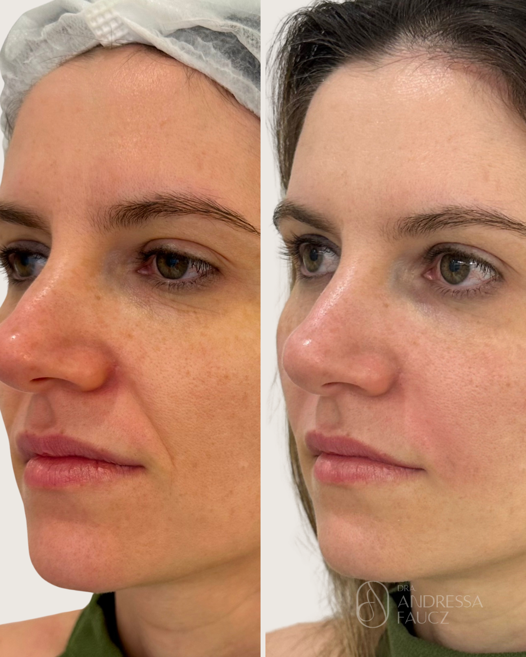 bigode-chines-preenchimento-antes-e-depois-curitiba-cabral-clinica-for-derm-1