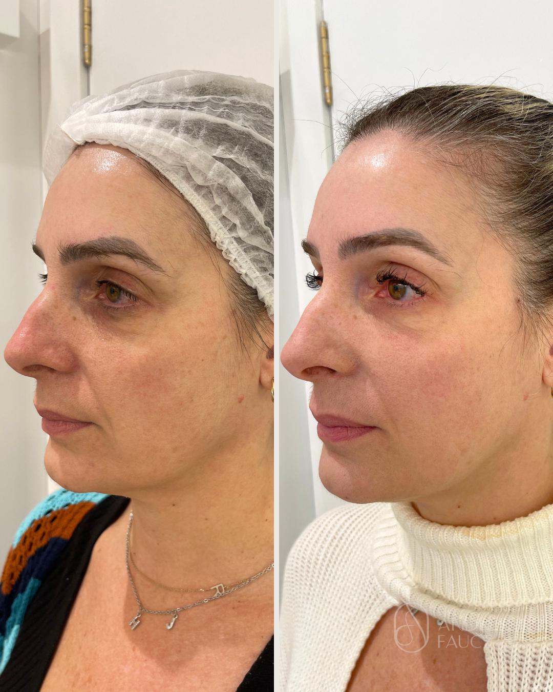 bioestimulador-de-colageno-harmonizacao-facial-antes-e-depois-curitiba-cabral-clinica-for-derm-1