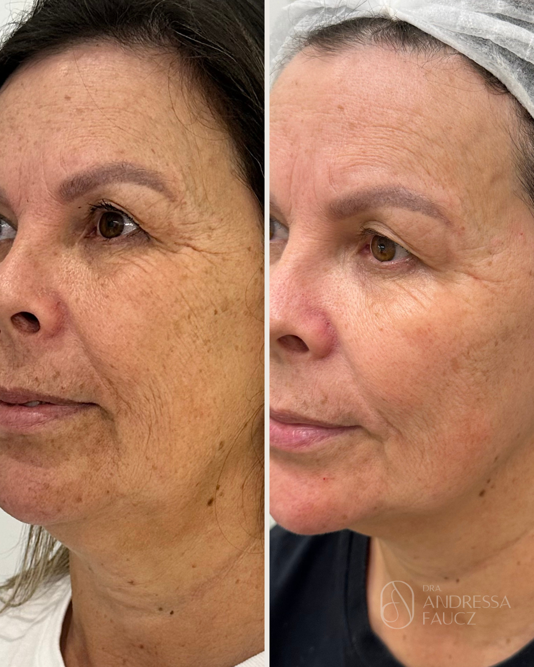 fusion-derm-tratamento-facial-harmonizacao-facial-antes-e-depois-curitiba-cabral-clinica-for-derm-1