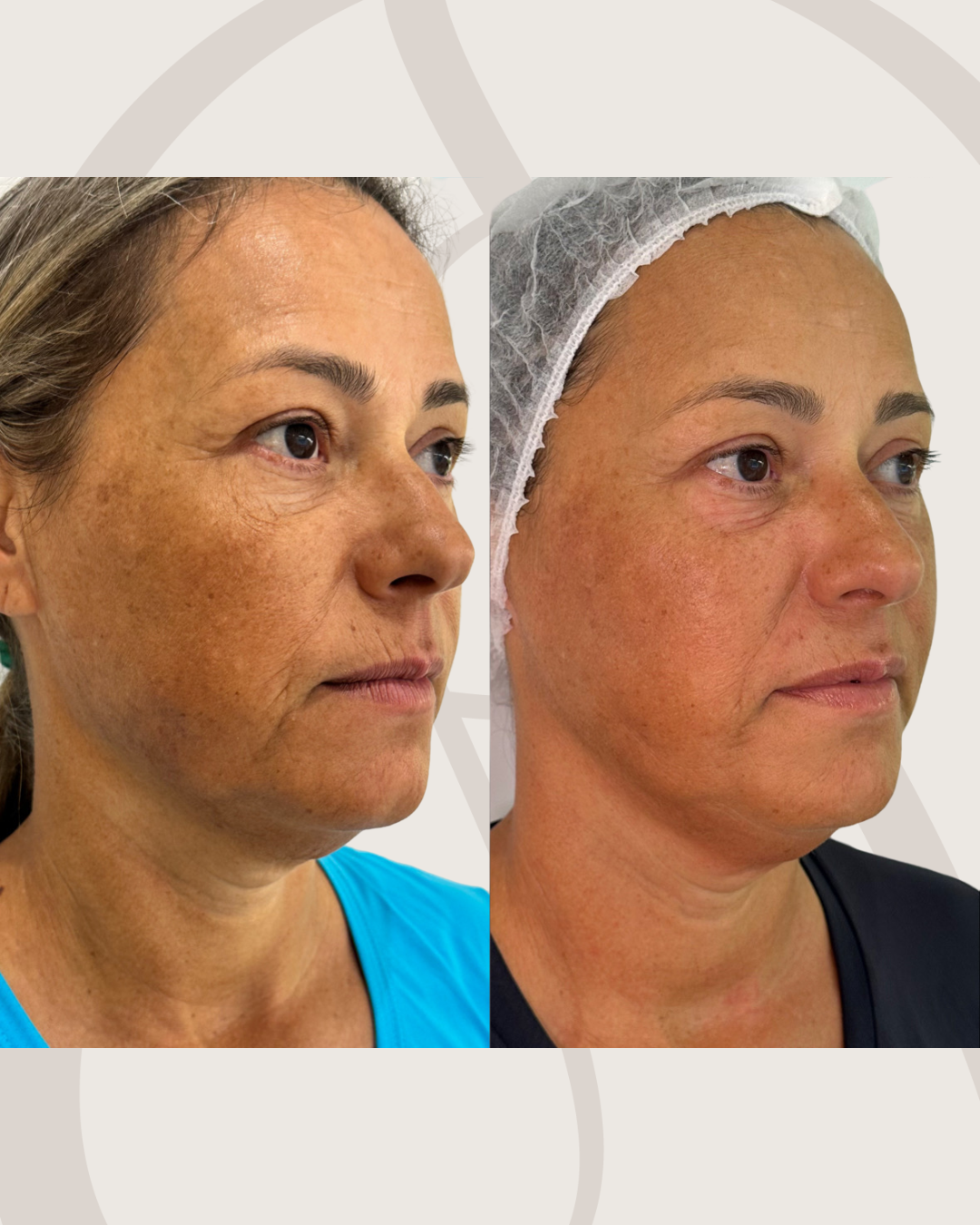 fusion-derm-tratamento-facial-harmonizacao-facial-antes-e-depois-curitiba-cabral-clinica-for-derm-2