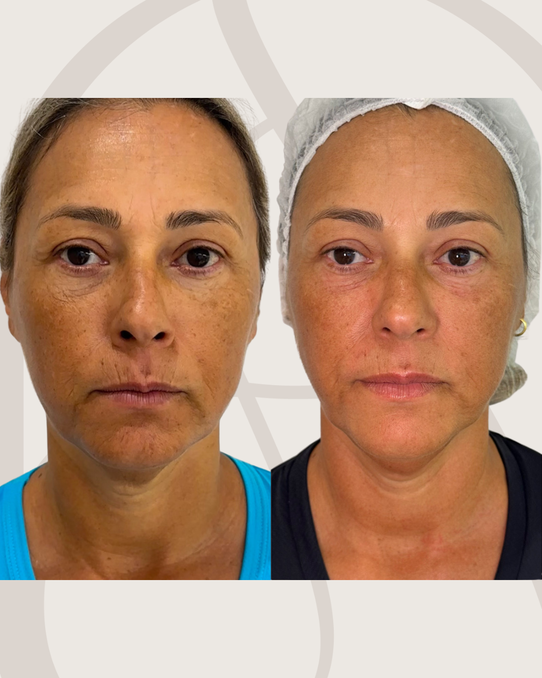 fusion-derm-tratamento-facial-harmonizacao-facial-antes-e-depois-curitiba-cabral-clinica-for-derm-3