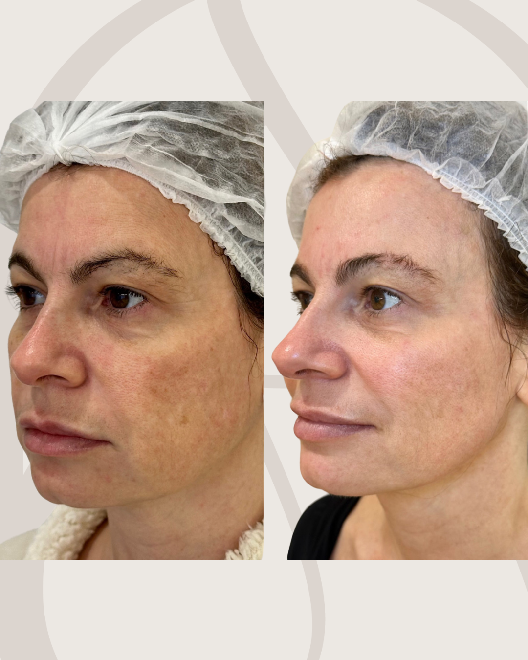 laser-pisom-harmonizacao-facial-antes-e-depois-curitiba-cabral-clinica-for-derm-1