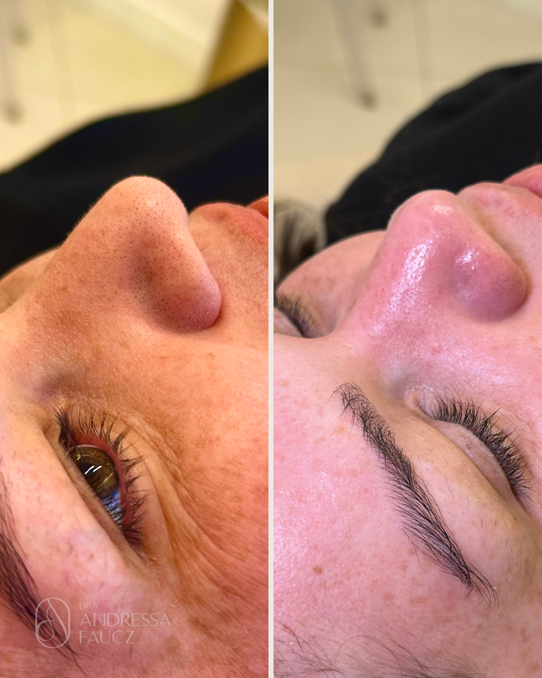 limpeza-de-pele-antes-e-depois-curitiba-cabral-clinica-for-derm-1