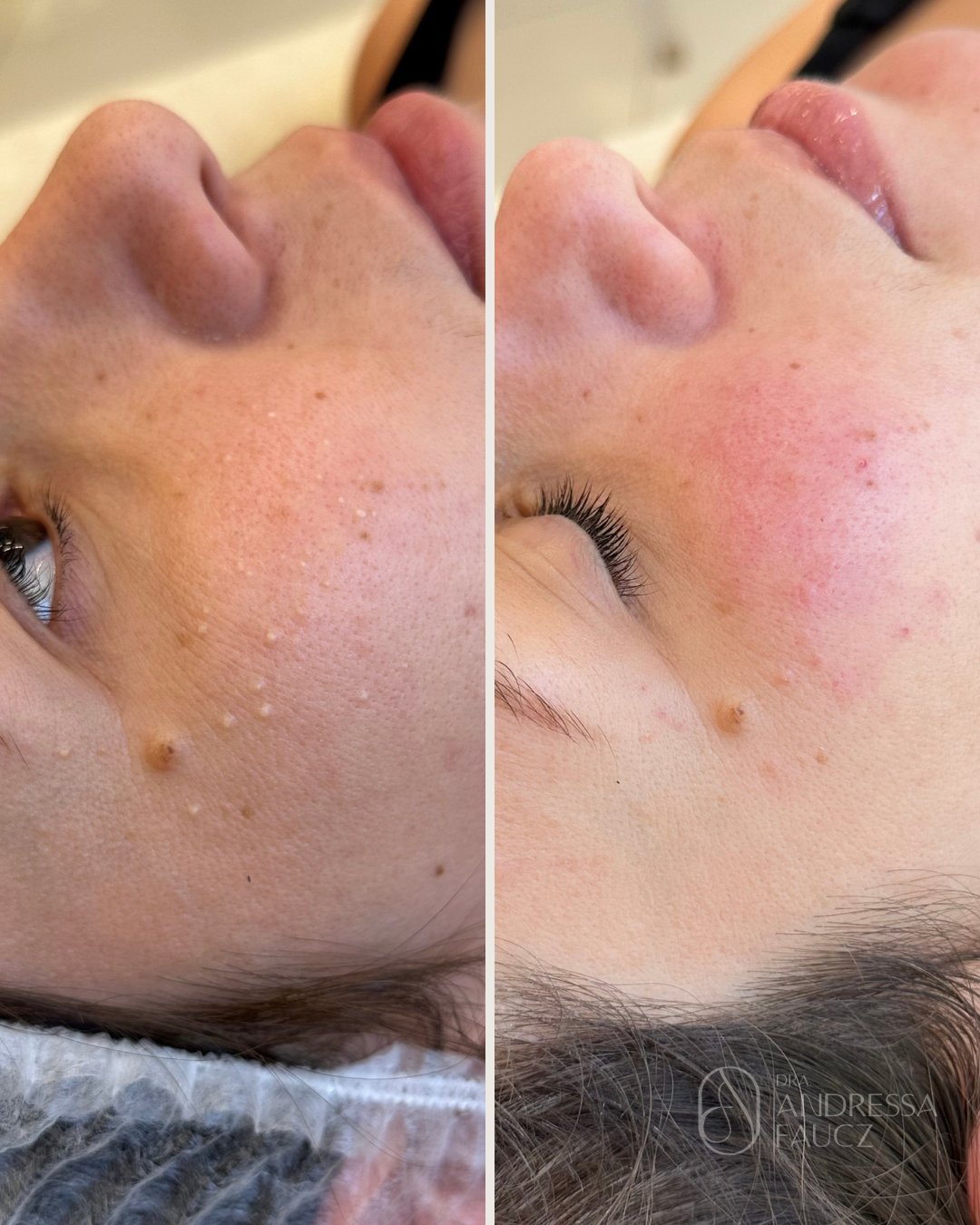 limpeza-de-pele-antes-e-depois-curitiba-cabral-clinica-for-derm-2