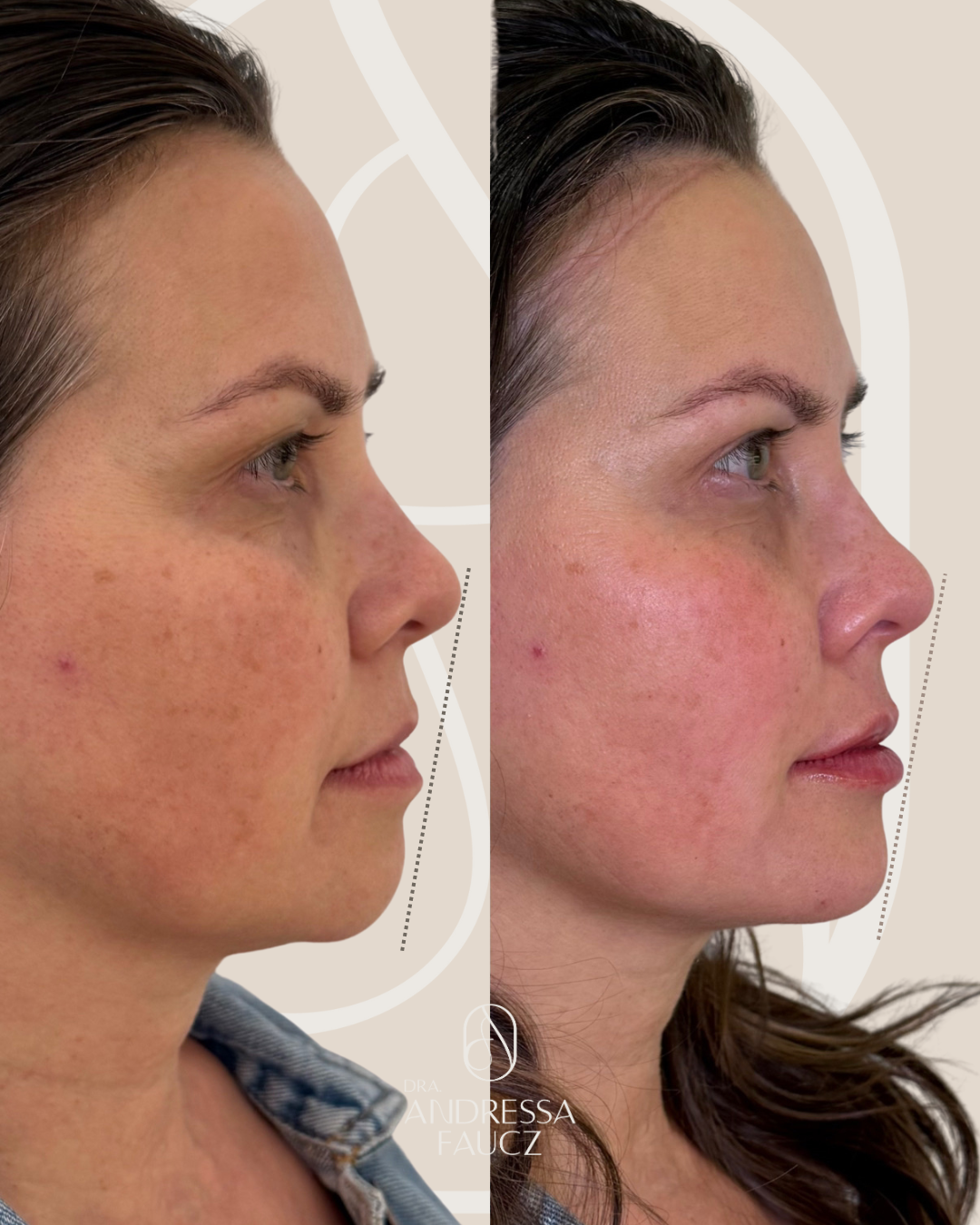 perfiloplastia-antes-e-depois-curitiba-cabral-clinica-for-derm-1