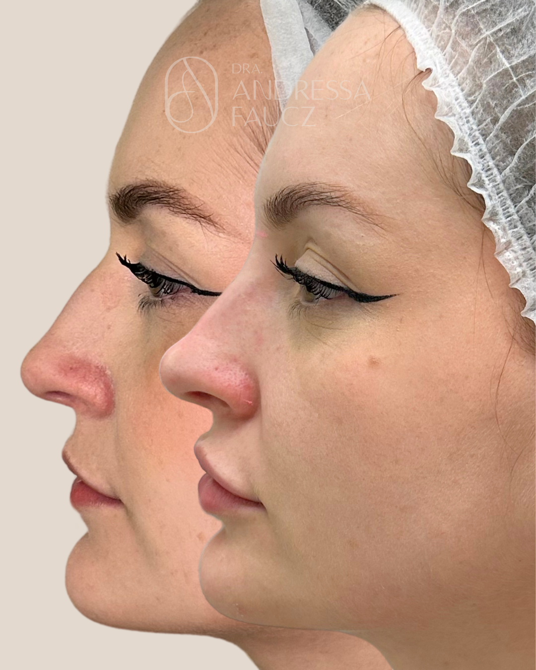 perfiloplastia-antes-e-depois-curitiba-cabral-clinica-for-derm-3