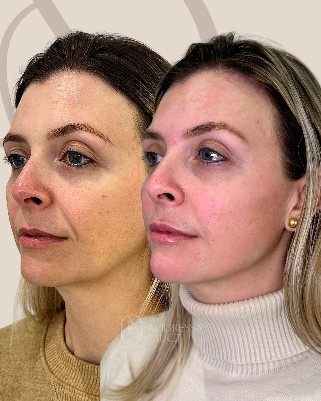 preenchimento-3m-mento-mandibula-malar-harmonizacao-facial-antes-e-depois-curitiba-cabral-clinica-for-derm-1