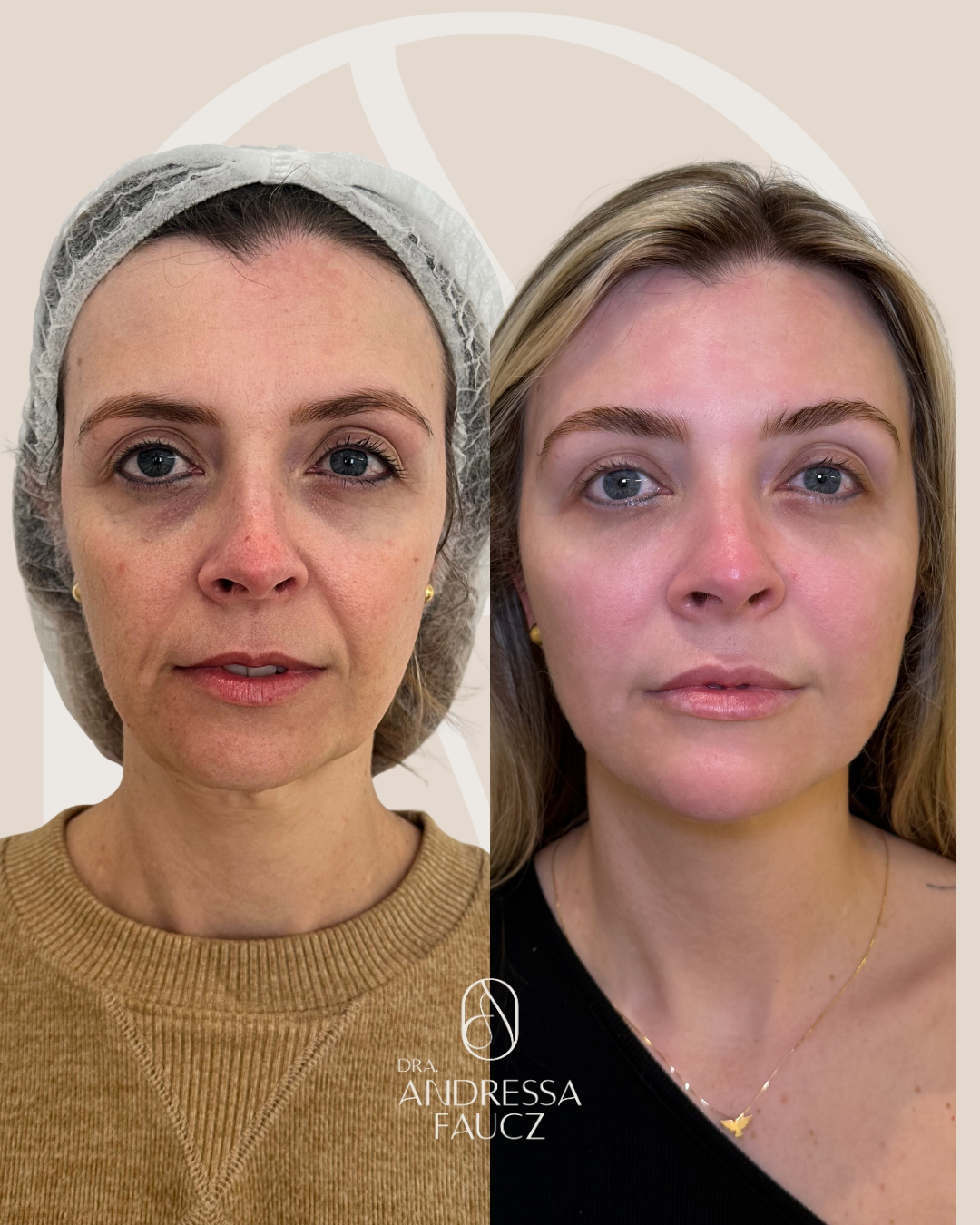 preenchimento-3m-mento-mandibula-malar-harmonizacao-facial-antes-e-depois-curitiba-cabral-clinica-for-derm-3