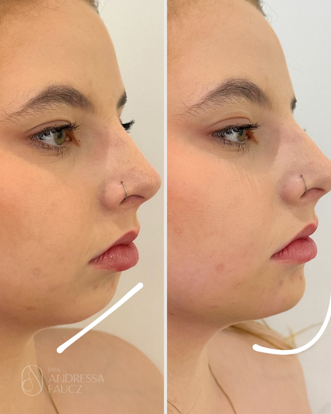 preenchimento-de-mento-queixo-facial-antes-e-depois-curitiba-cabral-clinica-for-derm-1