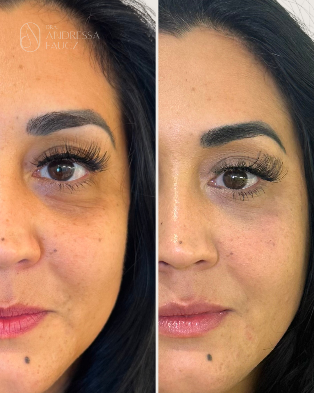 preenchimento-de-olheiras-antes-e-depois-curitiba-cabral-clinica-for-derm-1