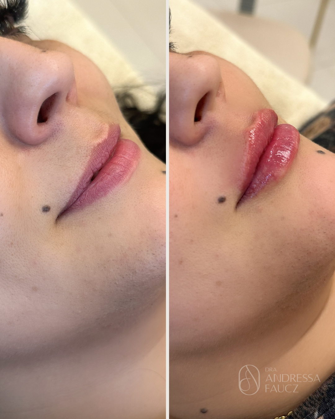 preenchimento-labiall-harmonizacao-facial-antes-e-depois-curitiba-cabral-clinica-for-derm-1