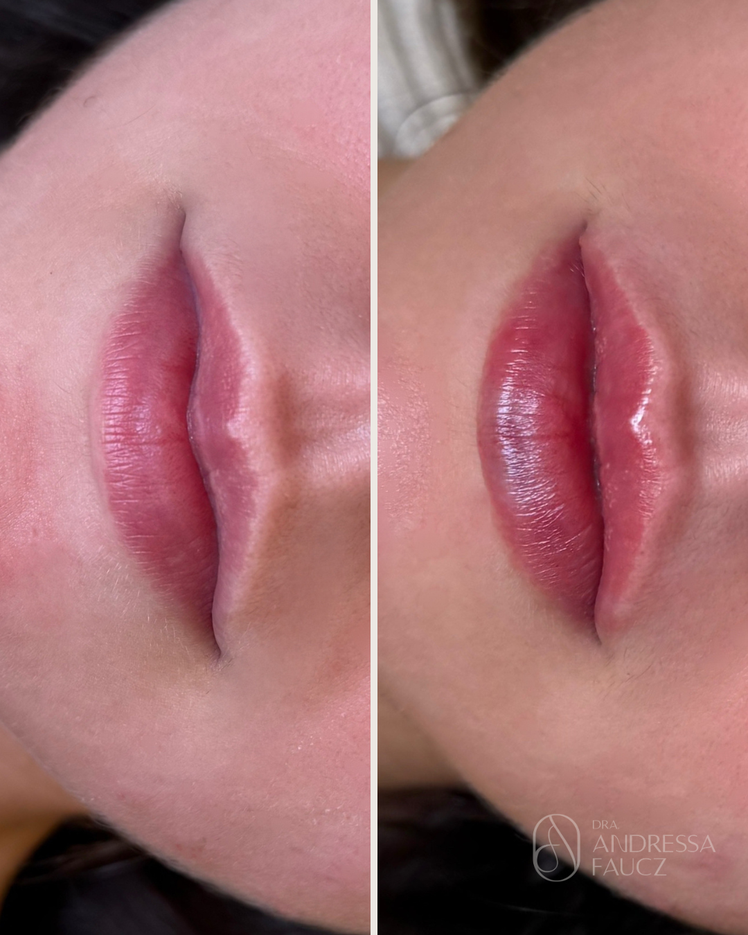 preenchimento-labiall-harmonizacao-facial-antes-e-depois-curitiba-cabral-clinica-for-derm-4