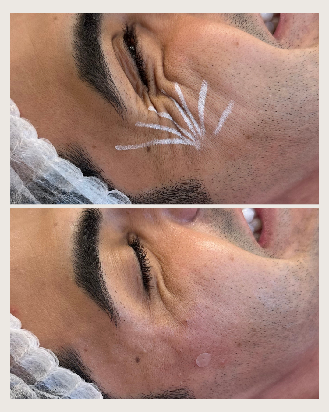 skinbooster-bioestimulador-de-colageno-antes-e-depois-curitiba-cabral-clinica-for-derm-1