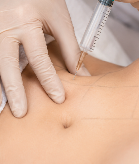 Profissional de estética usando luvas e seringa para realizar aplicação de bioestimulador de colágeno na região abdominal demarcada de uma paciente em Curitiba.