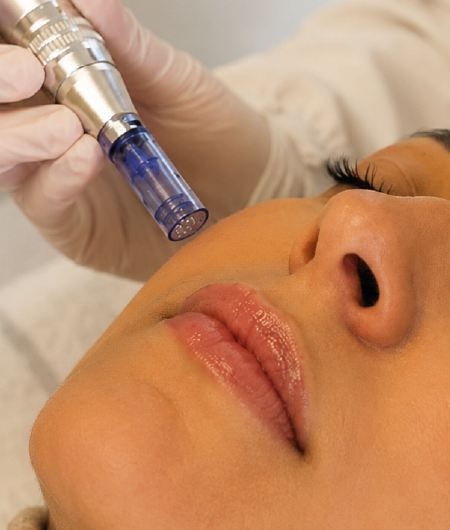 Profissional aplicando caneta de microagulhamento (Dermapen) no rosto de uma paciente para indução de colágeno e renovação celular em Curitiba.
