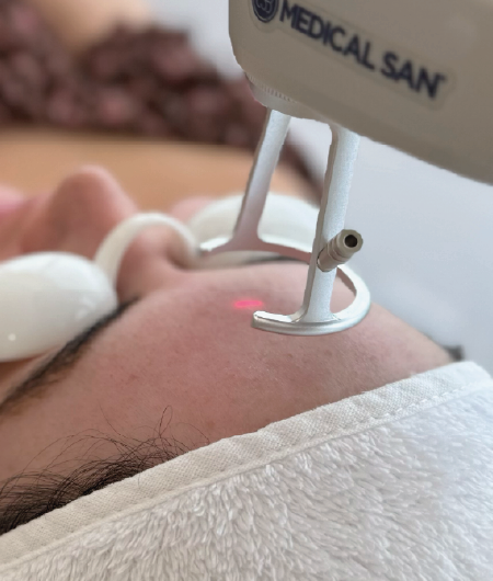 Aplicação de laser Lavieen na testa de uma paciente com óculos de proteção e faixa de cabelo branca, durante procedimento para rejuvenescimento e manchas em Curitiba.
