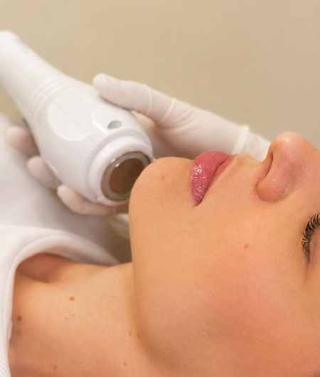 Profissional aplicando ponteira de radiofrequência fracionada na região da mandíbula de uma paciente deitada, para estímulo de colágeno e rejuvenescimento facial em Curitiba.
